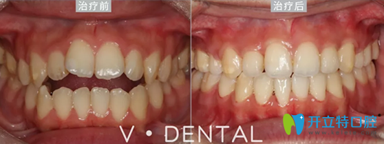 维恩口腔前牙开合矫正案例