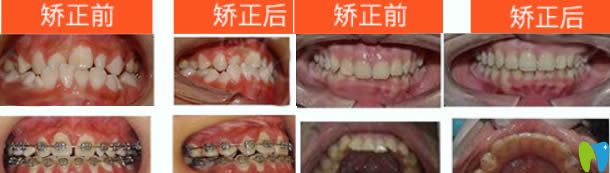 金属托槽矫正地包天及深覆颌对比图