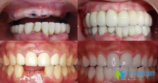 郑州卓 越口腔牙齿种植效果图