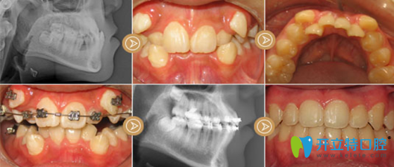 好佰年口腔虎牙矫正案例