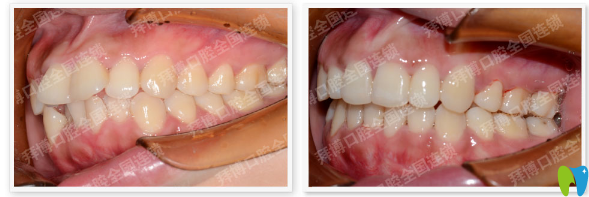 佛山拜博口腔牙齿矫正案例对比图