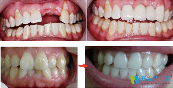 佛山壹加壹口腔种植牙+正畸效果案例