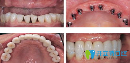 宁波牙博士种植牙效果对比图