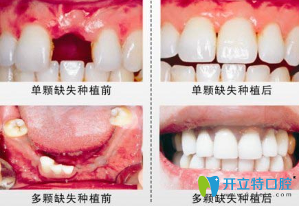 宁波恒美口腔种植牙案例效果图