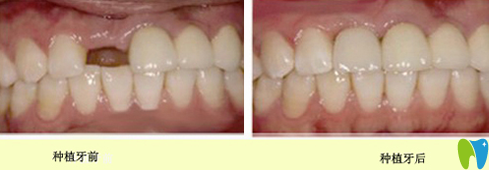 宁波恩吉口腔种植牙前后效果对比图