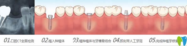 种植牙手术流程