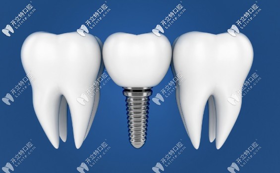 沈阳米兰齿科种植体特点