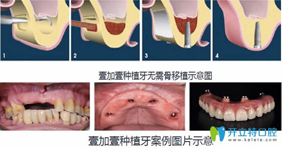 合肥壹加壹无需骨移植图示及种植牙案例图