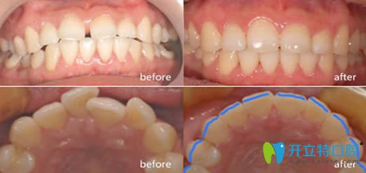 昆明吴氏嘉美泽众口腔牙齿矫正效果对比图