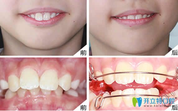 无锡金贝齐齿科牙齿矫正效果图