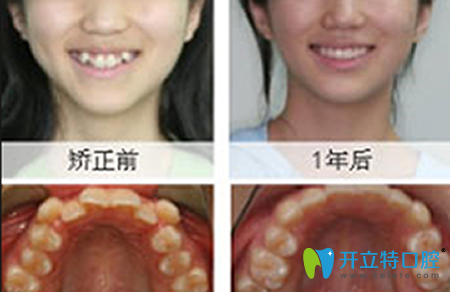 厦门登特口腔牙齿矫正前后效果对比图