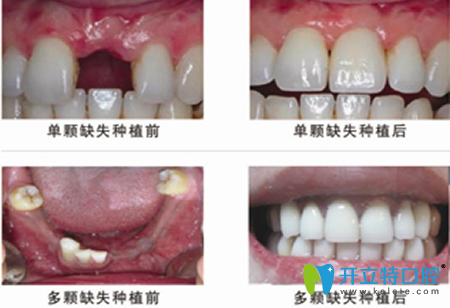 厦门登特口腔牙齿种植前后效果对比图