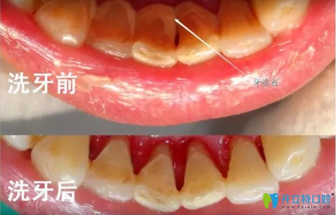 厦门博德口腔洗牙前后对比效果图