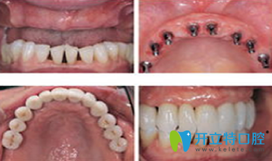 厦门天使口腔种植牙前后效果对比图