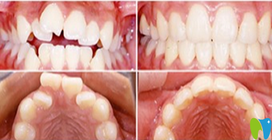 厦门天使口腔牙齿矫正效果对比图