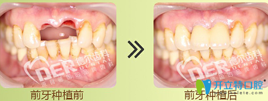 福州德尔齿科微创种植牙案例图