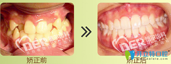 福州德尔齿科美学正畸效果图