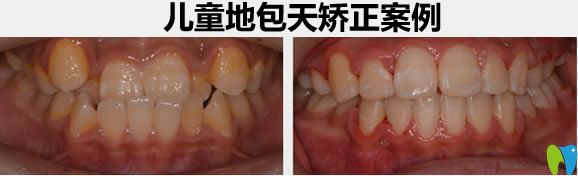 儿童地包天牙齿矫正前后以比效果