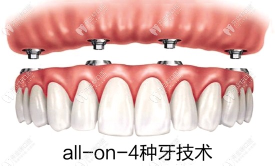 all-on-4种植牙技术