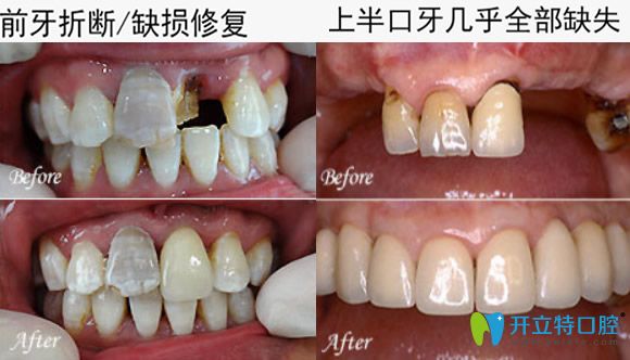 惠州致美口腔美学美学种植修复案例