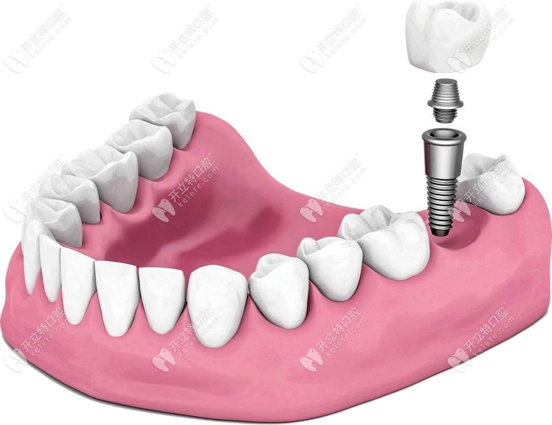 进口种植牙图示