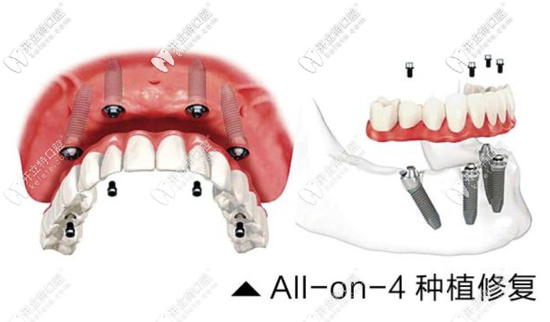 Allon4种植牙技术