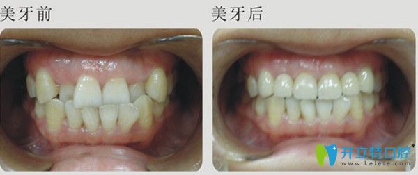 大连全好口腔牙齿矫正案例