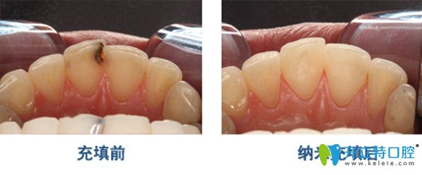 大连全好口腔补牙案例