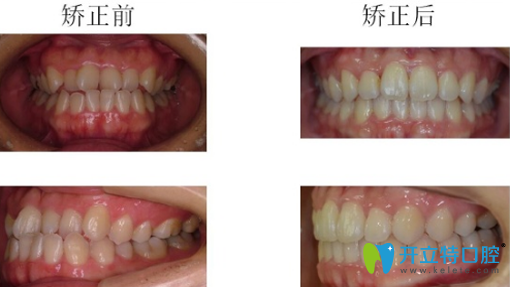 哈尔滨大象牙科牙齿隐形矫正前后正侧面对比图