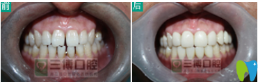 石家庄三博口腔牙齿矫正案例