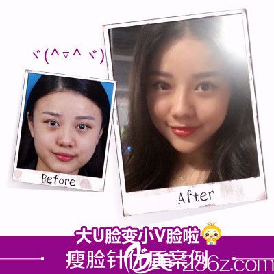 深圳美莱医疗整形美容医院瘦脸针案例