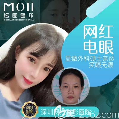 深圳铭医刘昕医生双眼皮案例