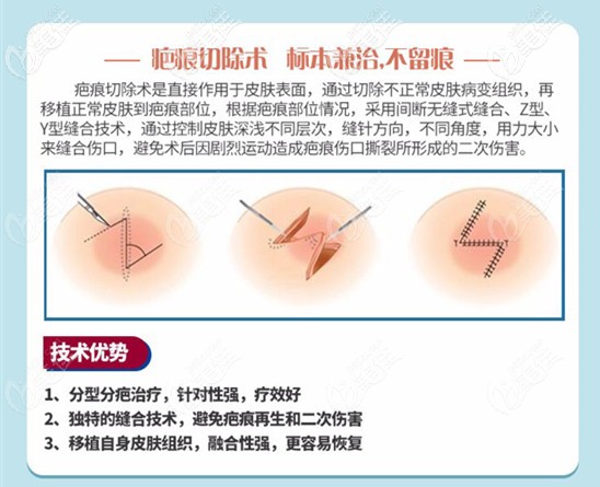 疤痕切除术的技术优惠