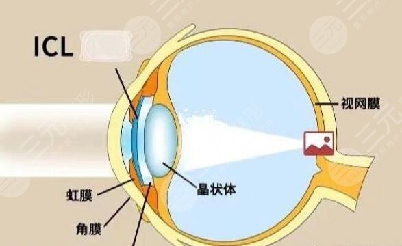 中山大学中山眼科中心全飞秒治疗案例