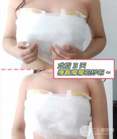 隆胸案例：