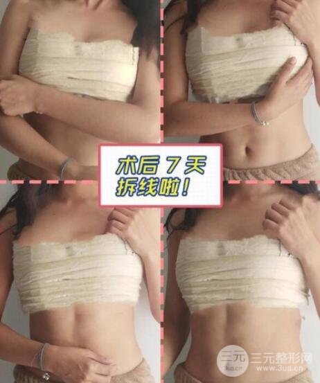 隆胸案例：