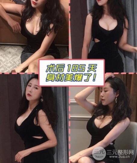隆胸案例：