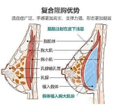 沈阳杏林整形医院丰胸案例分享