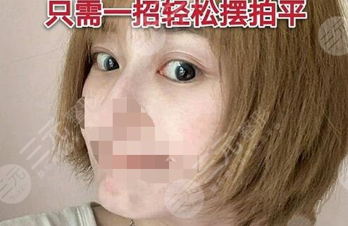 祛眼袋案例后