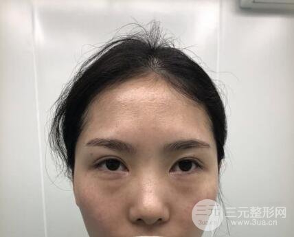 祛眼袋手术案例
