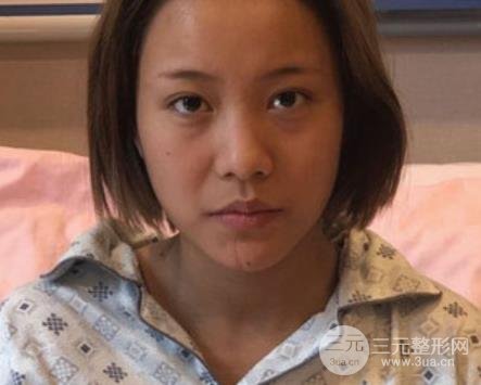 徐州二院整形科价格表更新&医生名单&隆鼻案例~