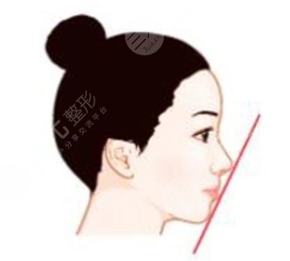 太原,华美,整形,医院,隆鼻,手术,果,自然
